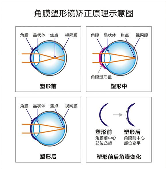 角膜塑形镜原理图.jpg