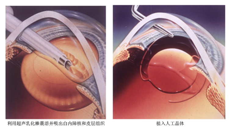 白内障超声乳化手术图.jpg