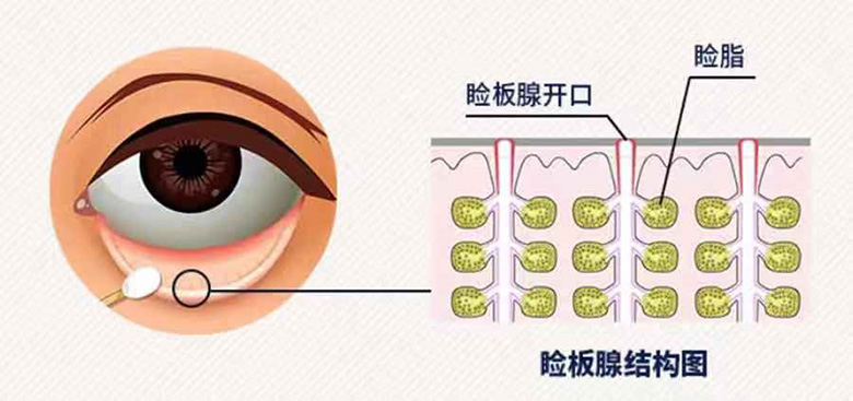 干眼症的隐形杀手睑板腺功能障碍