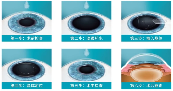 近视手术界的爱马仕 Icl 值得近视患者投入吗 兴齐眼科医院 近视手术界的爱马仕 Icl 值得近视患者投入吗 兴齐眼科医院
