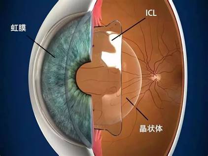 关于高端近视矫正手术 Icl 你想知道的都在这 兴齐眼科医院